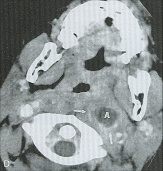 Abcès retro-pharyngé